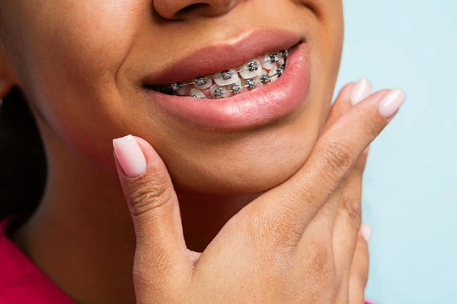 Metal Braces